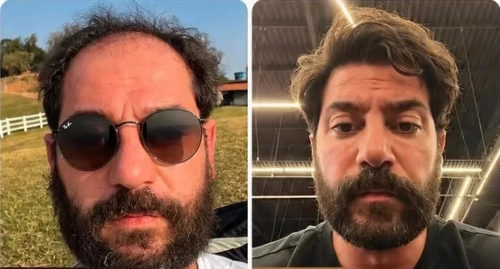 Fotos de antes e depois enviadas pela clínica Gianoto Hair